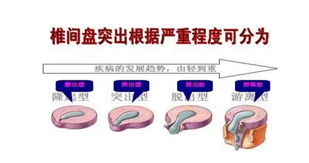 椎间盘膨出最佳治方法