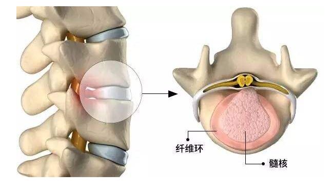 椎间盘膨出最佳治方法