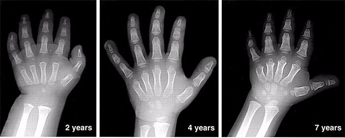 为什么要给孩子测骨龄？什么时候测最好？