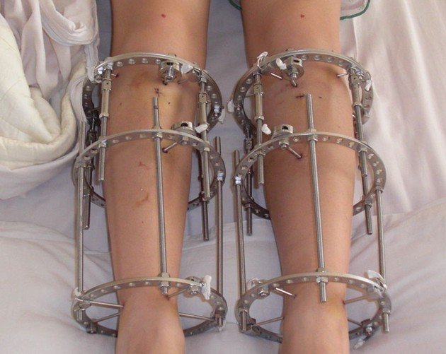 怎样让腿变直变长变细