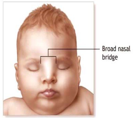 瓦登伯革氏症候群的致病机转