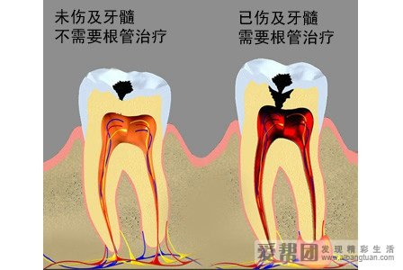 龋齿图片 蛀牙龋齿 ？？