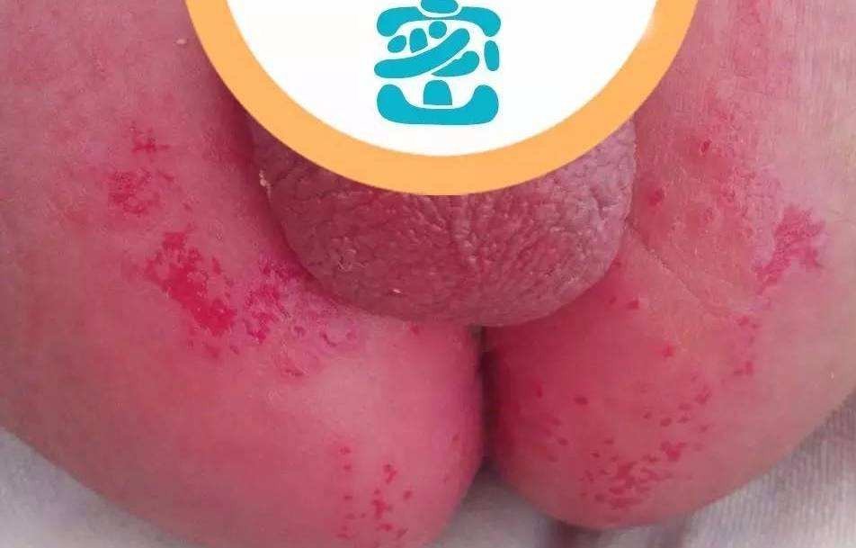 尿布疹图片是什么样？