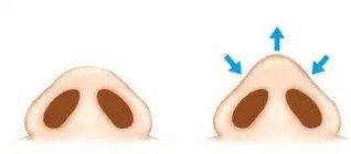 鼻头肥大怎么缩小鼻头？