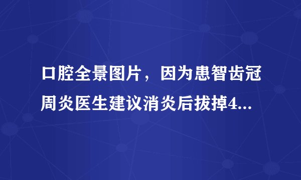 口腔全景图片，因为患智齿冠周炎医生建议消炎后拔掉4颗智齿，请名医为我分析下，给出建议