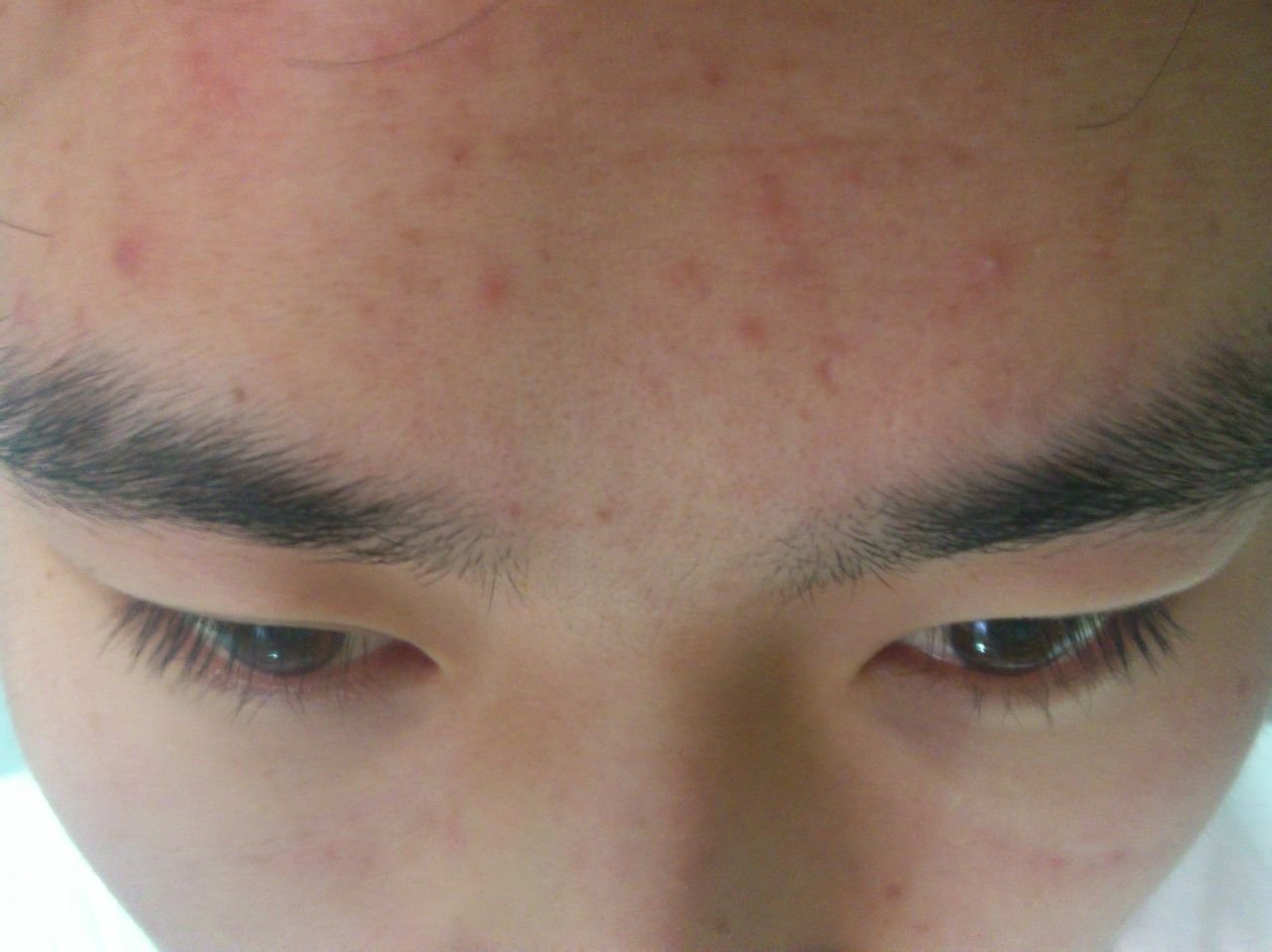 粉刺图片，怎么判断自己是不是封闭性粉刺？