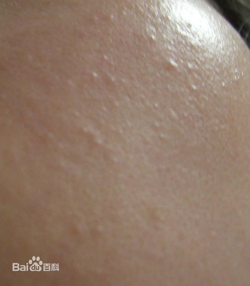 粉刺图片，怎么判断自己是不是封闭性粉刺？