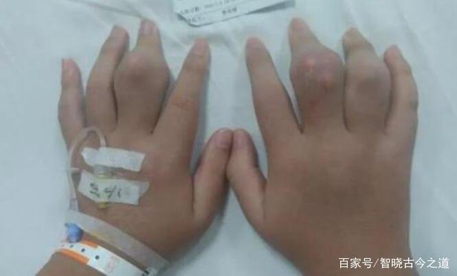 22岁女教师因奶茶小便失禁,血液全成乳白色,美味奶茶为何如此可怕?