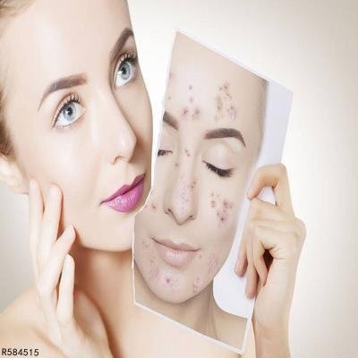 女生青春痘的治疗方法是什么