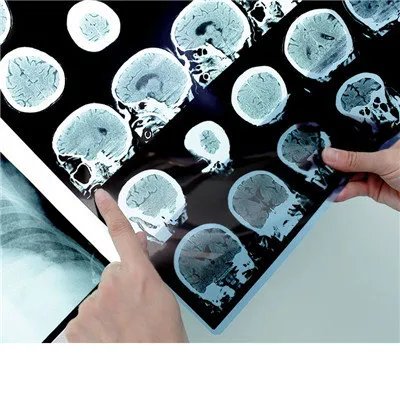 脑出血症状有哪些