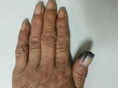 肢端雀斑痣样黑素瘤黑斑图片