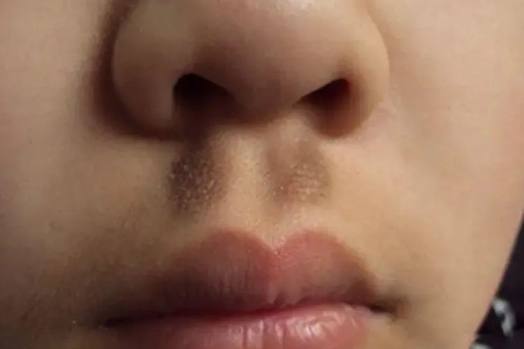 黑变病面部黑斑图片