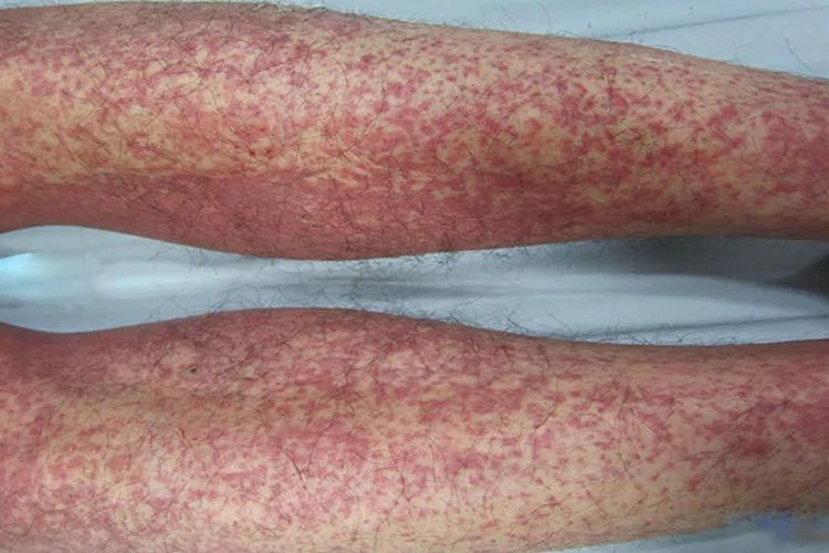 过敏性皮疹图片