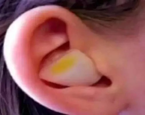 洋葱放入耳朵一夜竟然出现奇迹了（图）