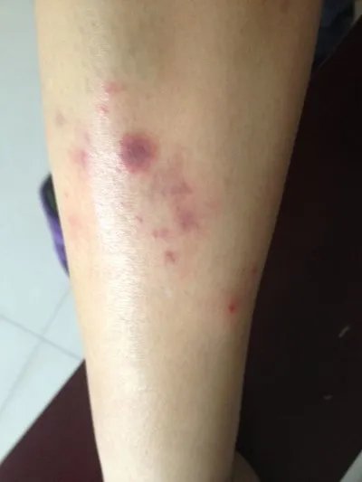 过敏性紫癜的症状表现