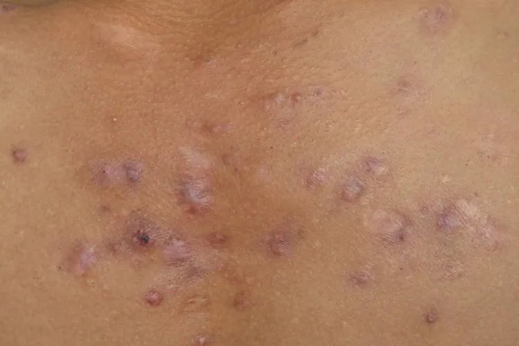 过敏性皮疹图片