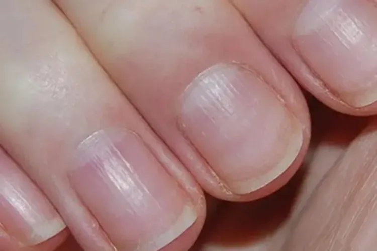 先天性角化不良竖纹图片