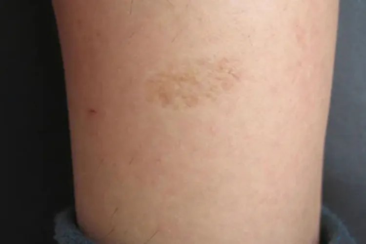 无红斑性皮肤松弛症皮肤缺损图片