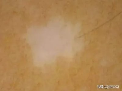 白色老年斑图片