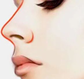 假体隆鼻大约需要多少钱