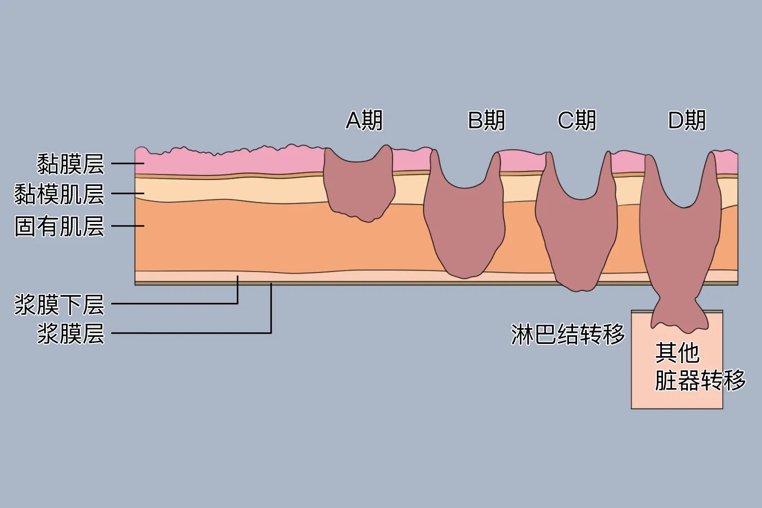 乙状结肠腺癌分期图片