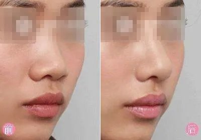 深圳最好的整形医院鼻部整形手术的价格 