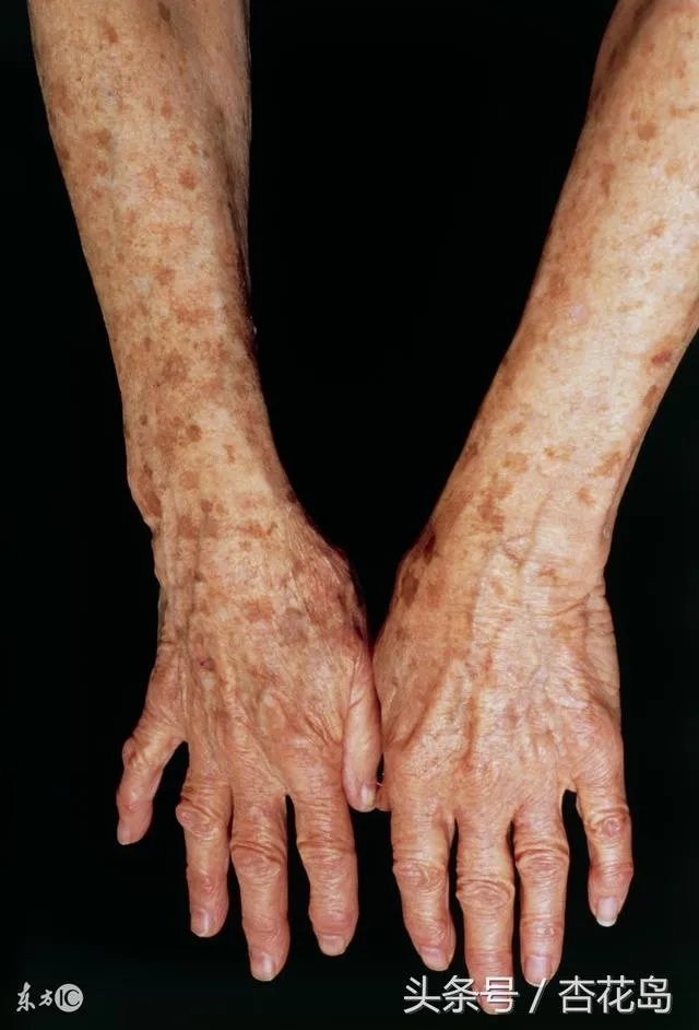 老年斑是怎么回事？