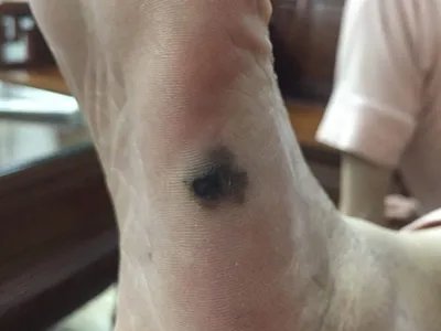 肢端雀斑痣样黑素瘤黑斑图片