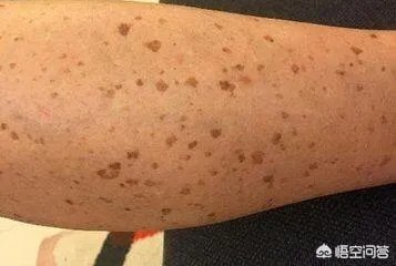 老年斑是怎么回事？