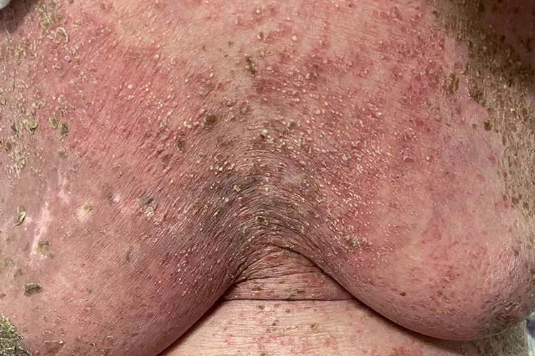 过敏性皮疹图片