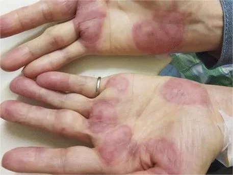 急性发热性嗜中性皮病手掌症状图片