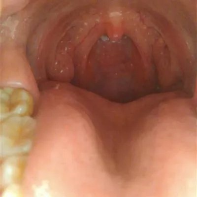 过敏性咽炎应该怎么治疗?