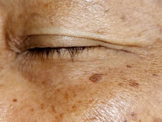 怎么才能去除黄褐斑