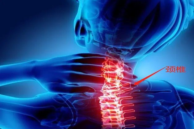 颈椎病图片