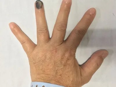 肢端雀斑痣样黑素瘤黑斑图片