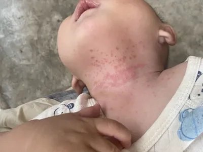 间擦疹丘疹图片