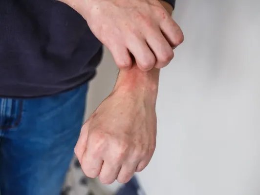 手部湿疹如何治疗