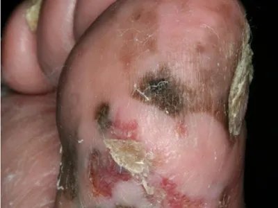 肢端雀斑痣样黑素瘤黑斑图片