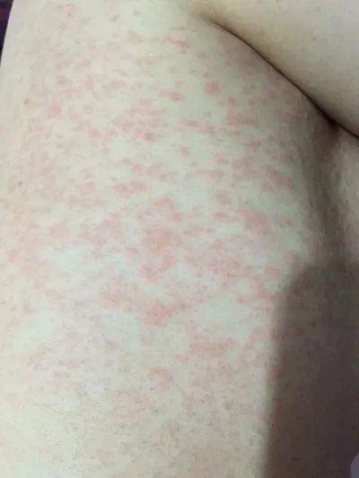 过敏性紫癜的症状表现