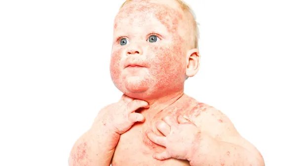 手癣脚癣怎么根治