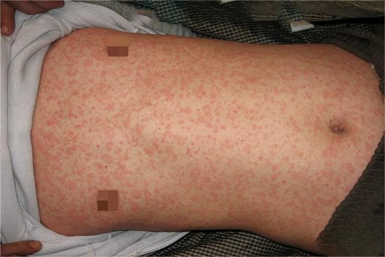 过敏性皮疹图片