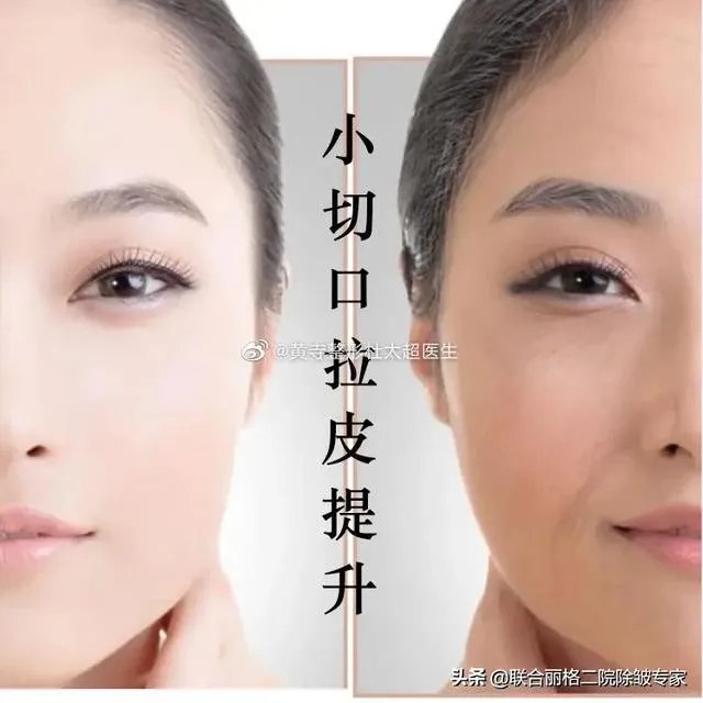 面部除皱最好的方法是什么？