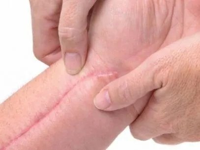 手术疤痕治疗需要如何去除