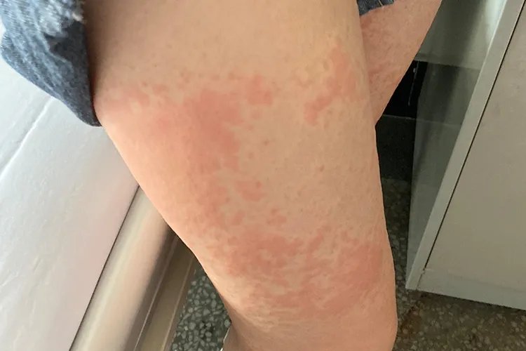 过敏性皮疹图片