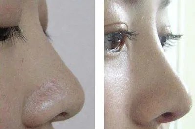 鼻翼缩小前后对比图