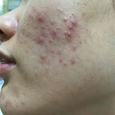 怎么样快速治疗痤疮