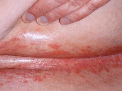 间擦疹丘疹图片