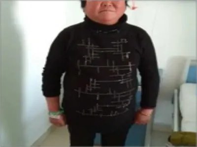 库欣综合征肥胖图片