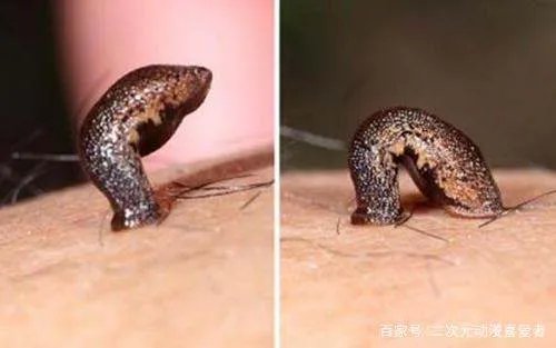 活体蚂蟥在5岁男孩体内存留1年多，体内有蚂蟥会有哪些症状？