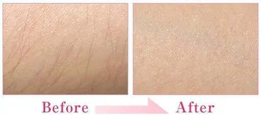 一次激光脱毛需要多长时间